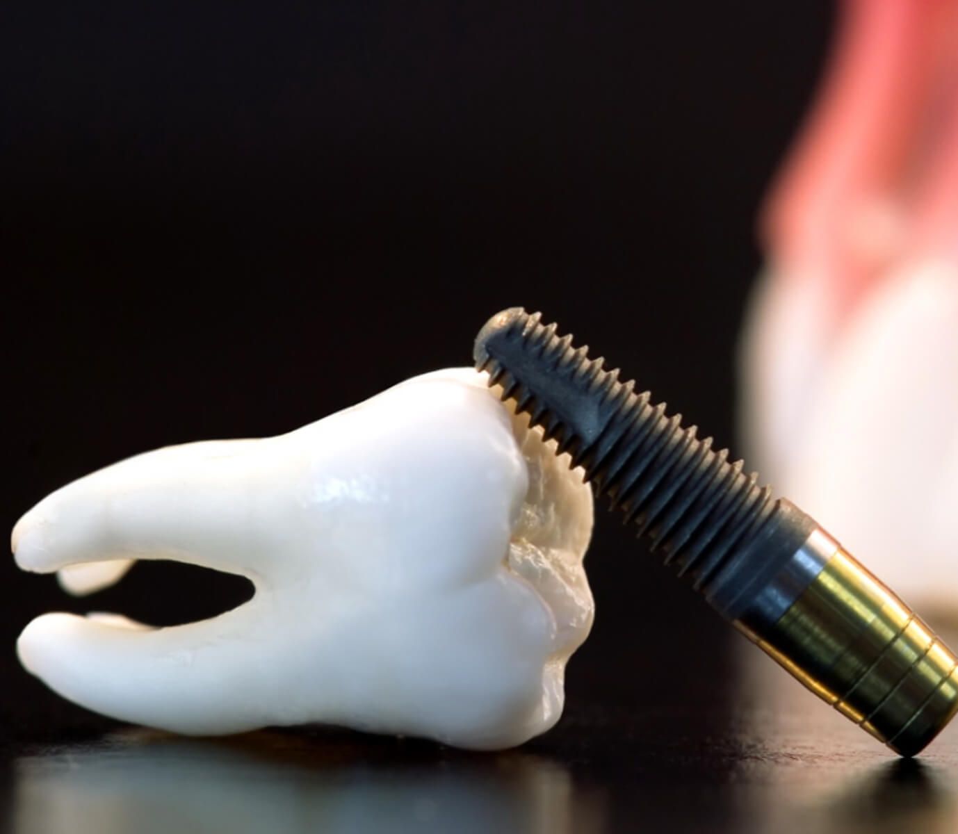 Имплантация зуба "под ключ"
