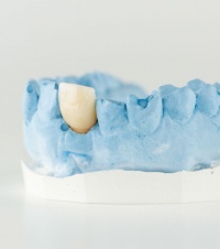 Стоимость пластмассовой коронки на зуб